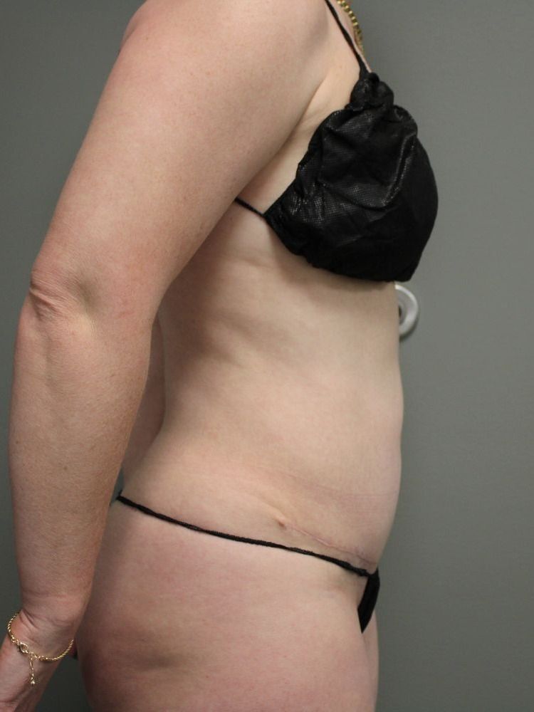 Tummy Tuck Before & After