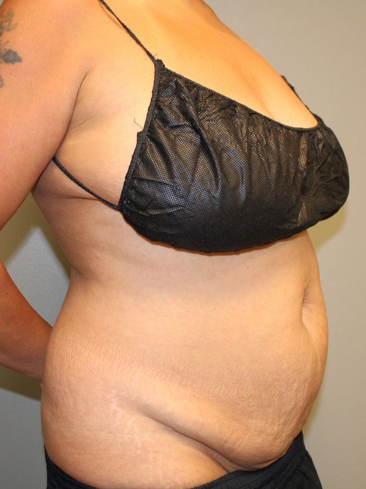 Tummy Tuck Before & After