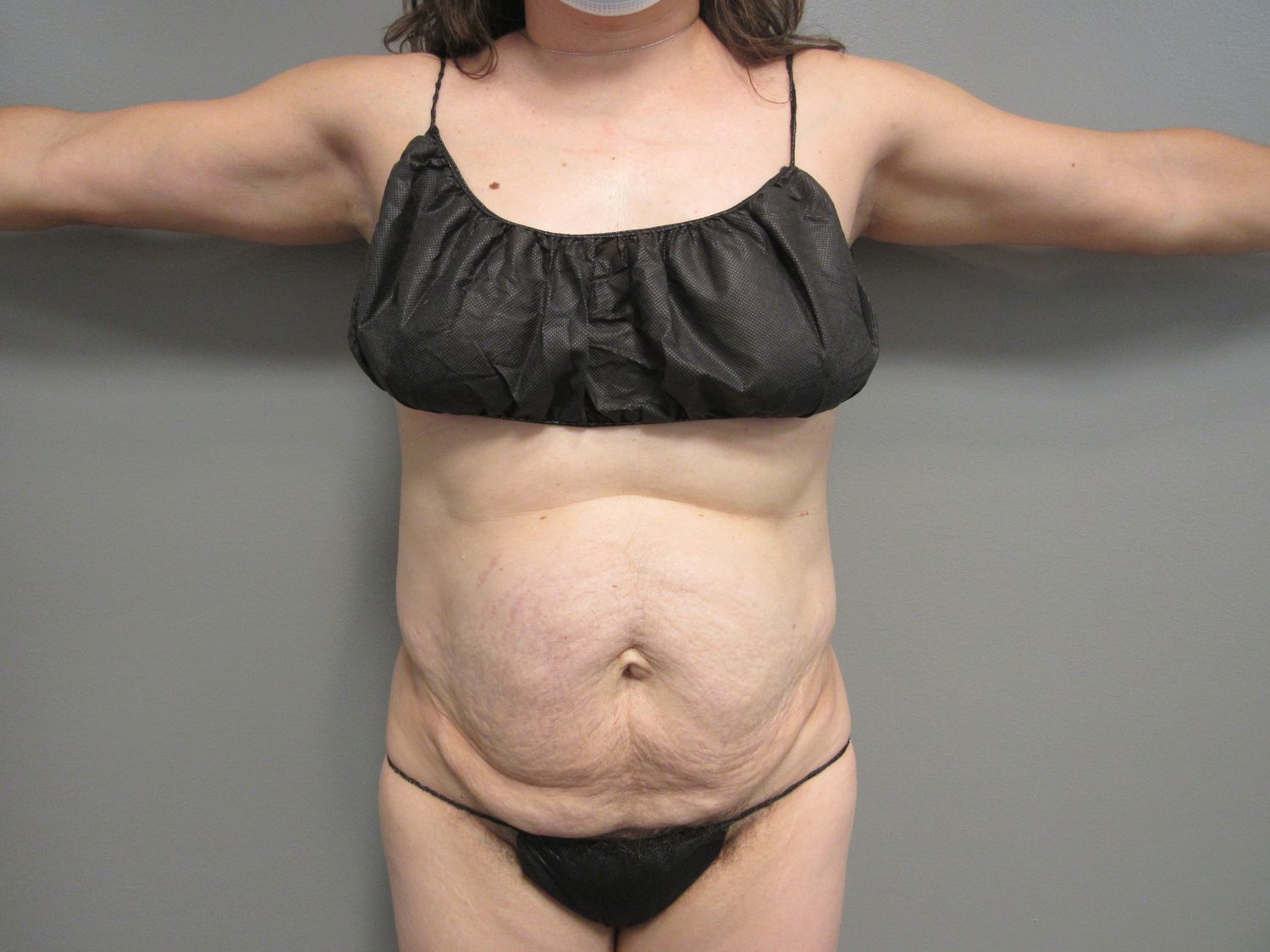 Tummy Tuck Before & After