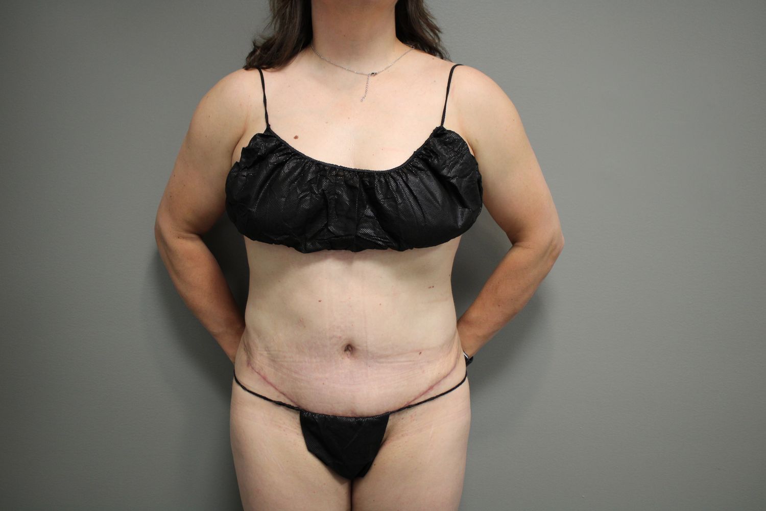 Tummy Tuck Before & After