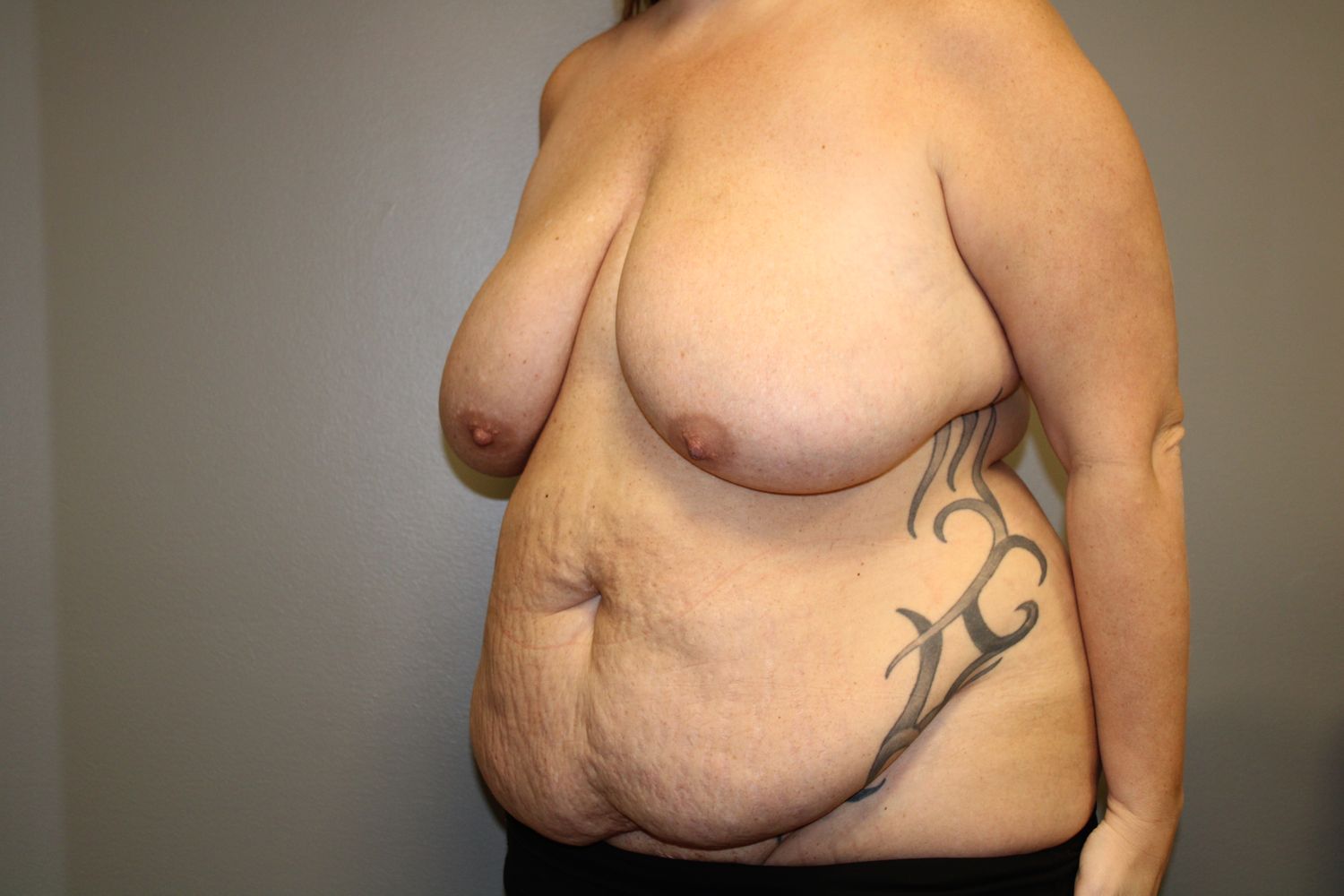 Tummy Tuck Before & After