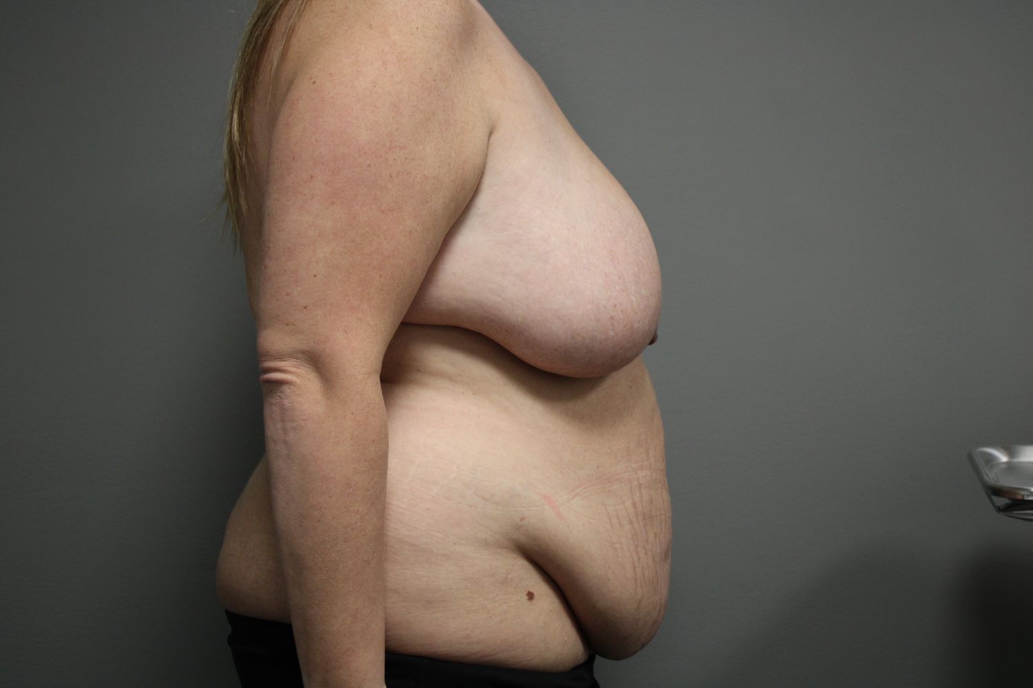 Tummy Tuck Before & After