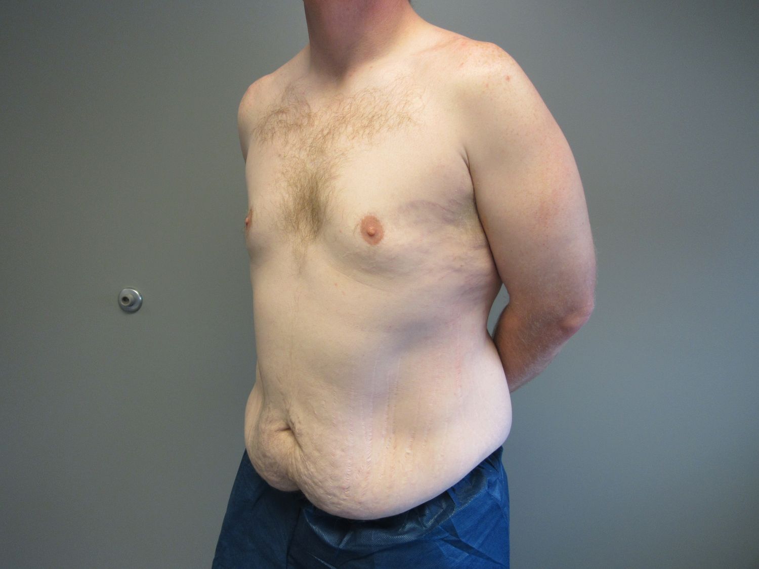 Tummy Tuck Before & After