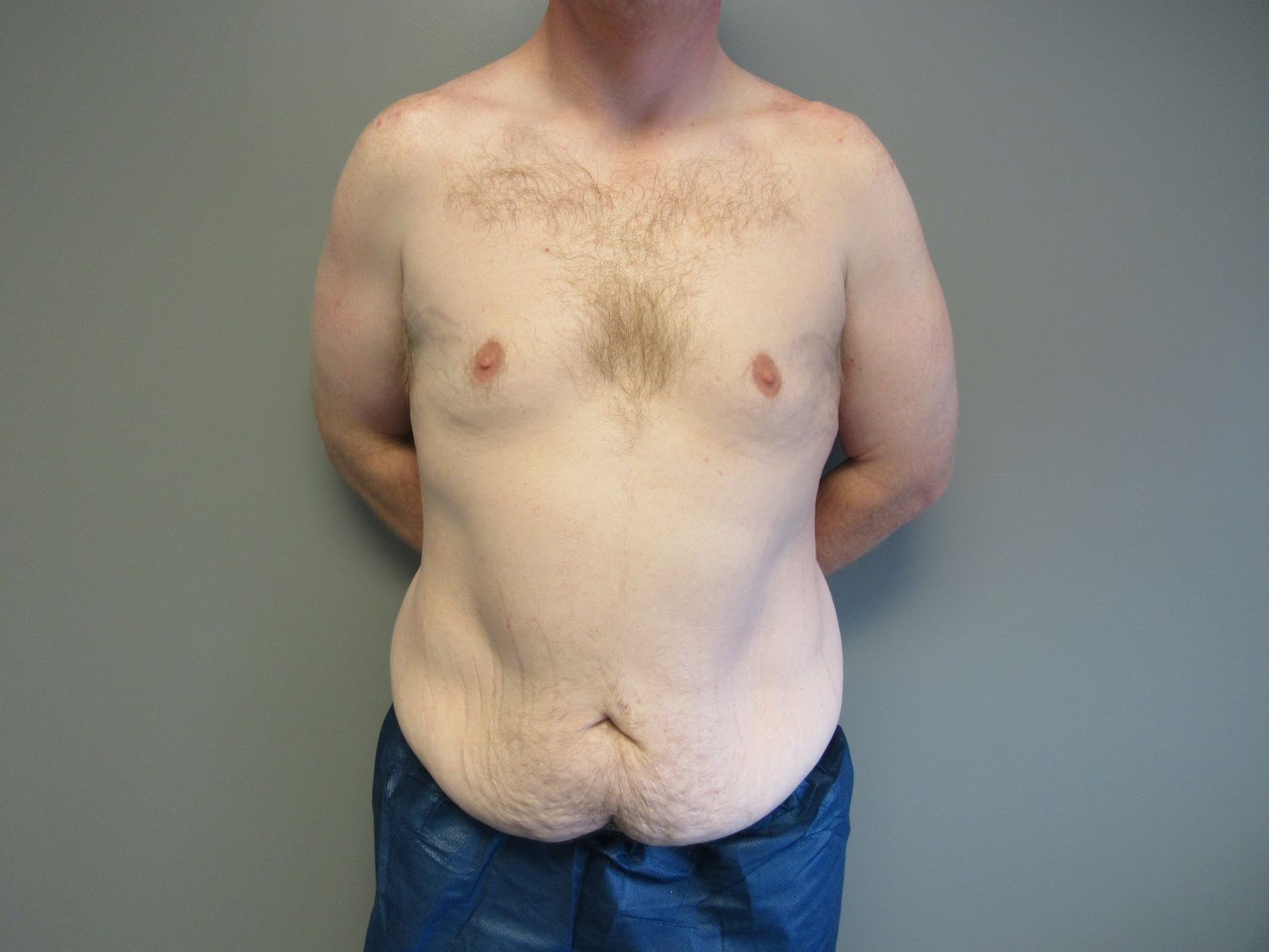 Tummy Tuck Before & After