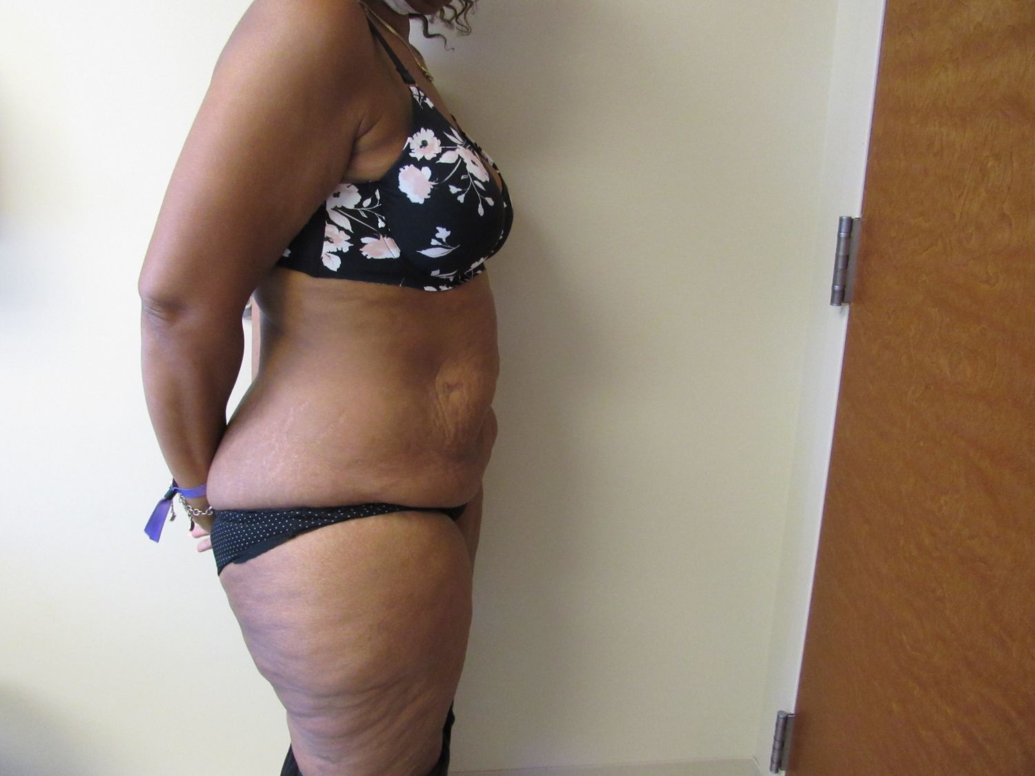 Tummy Tuck Before & After