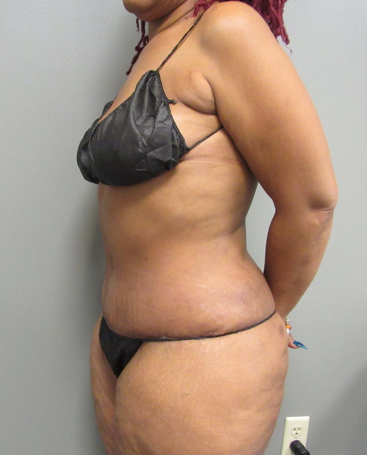 Tummy Tuck Before & After