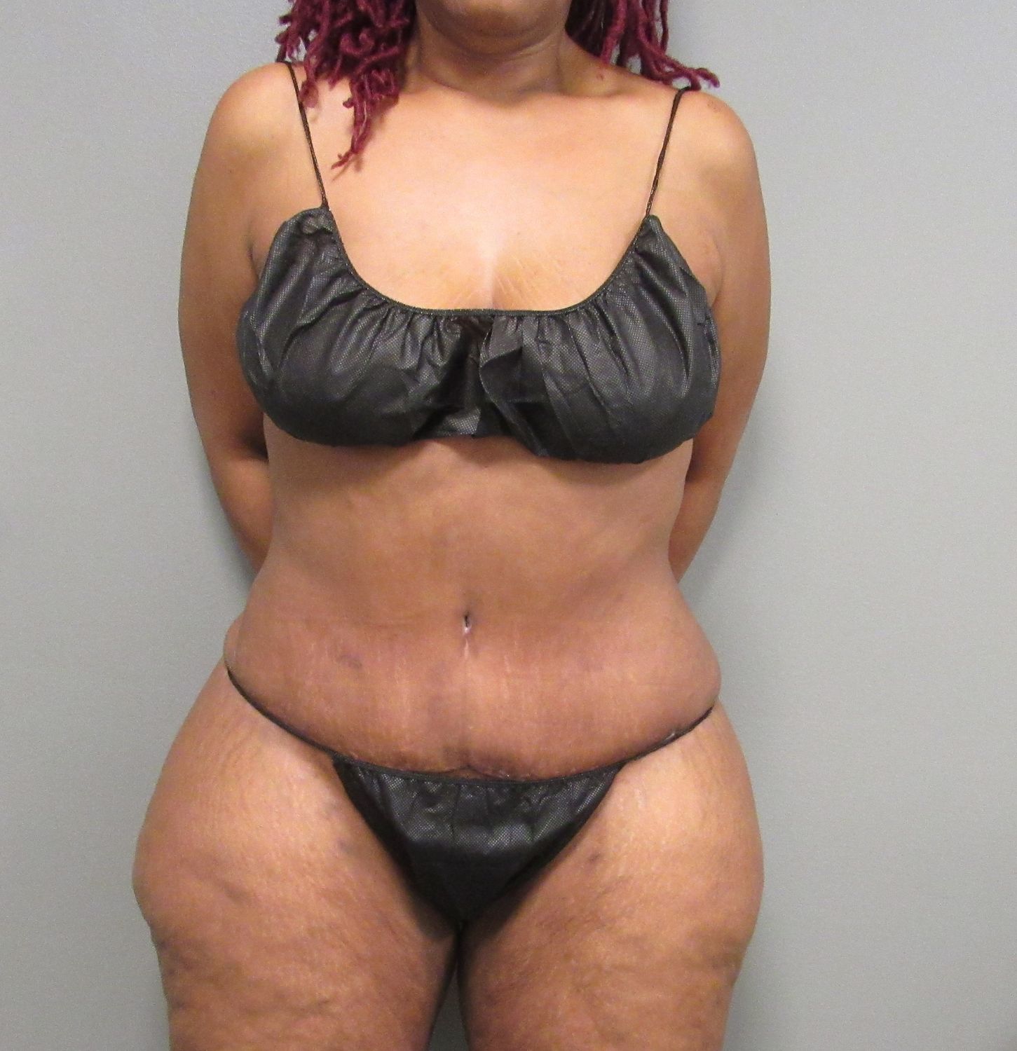 Tummy Tuck Before & After