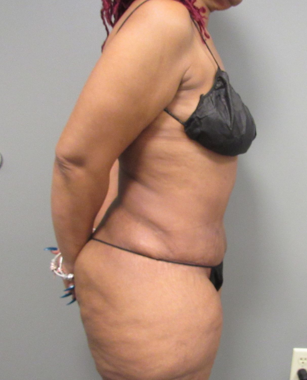 Tummy Tuck Before & After