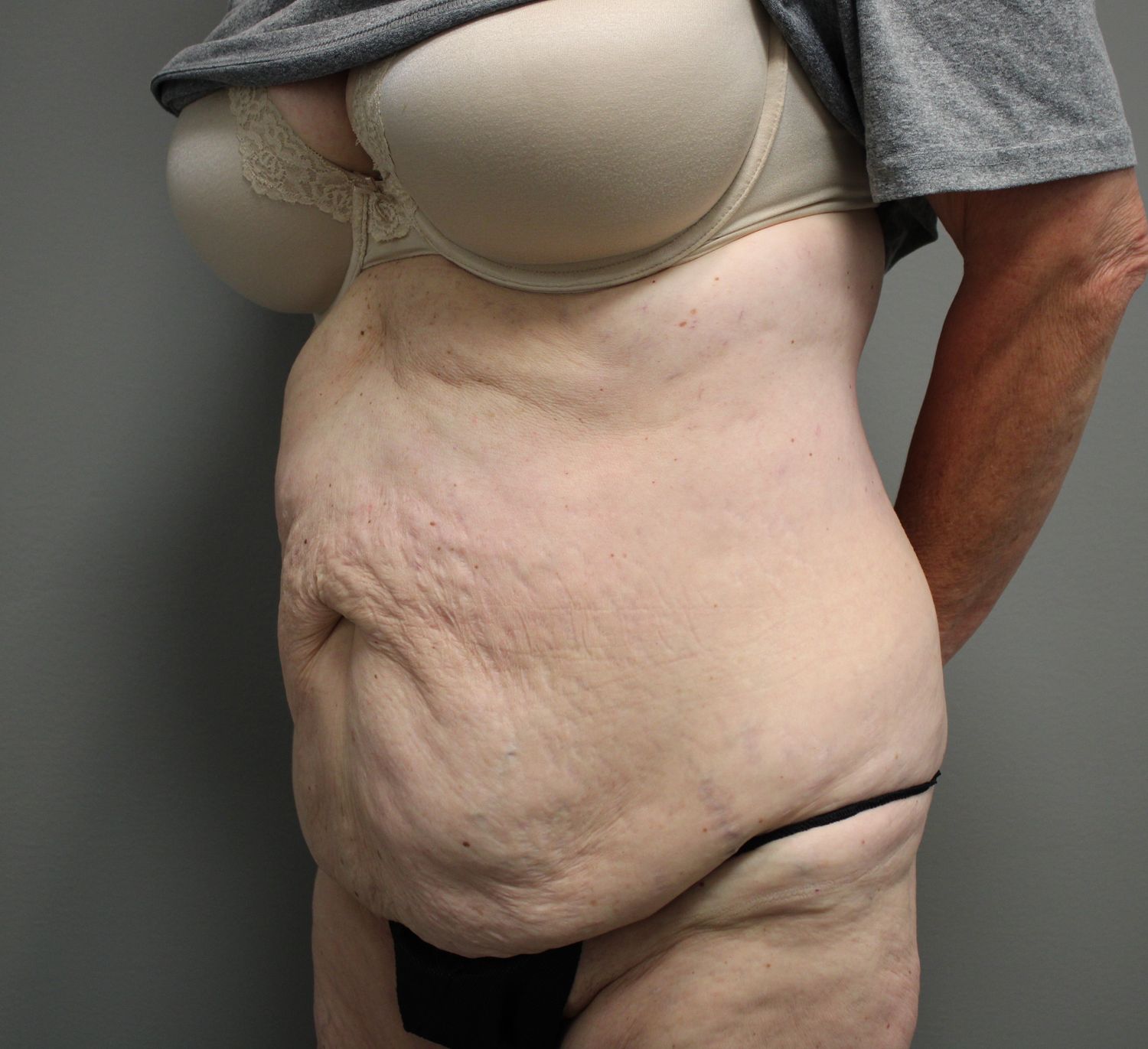 Tummy Tuck Before & After