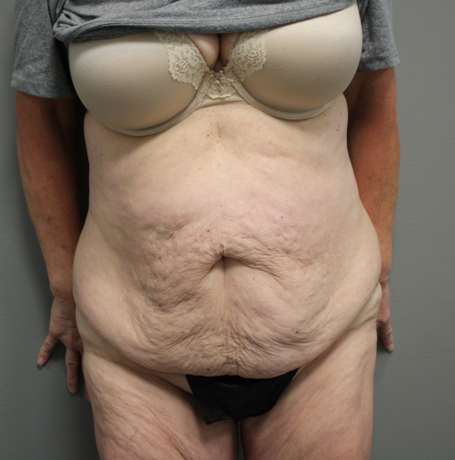 Tummy Tuck Before & After