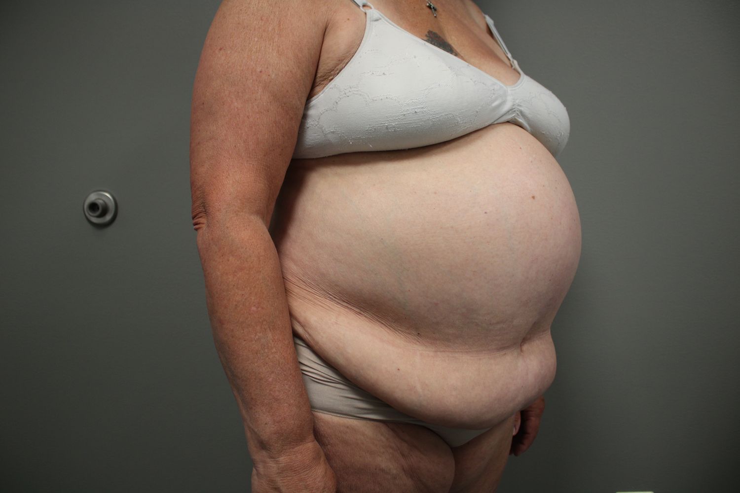 Tummy Tuck Before & After