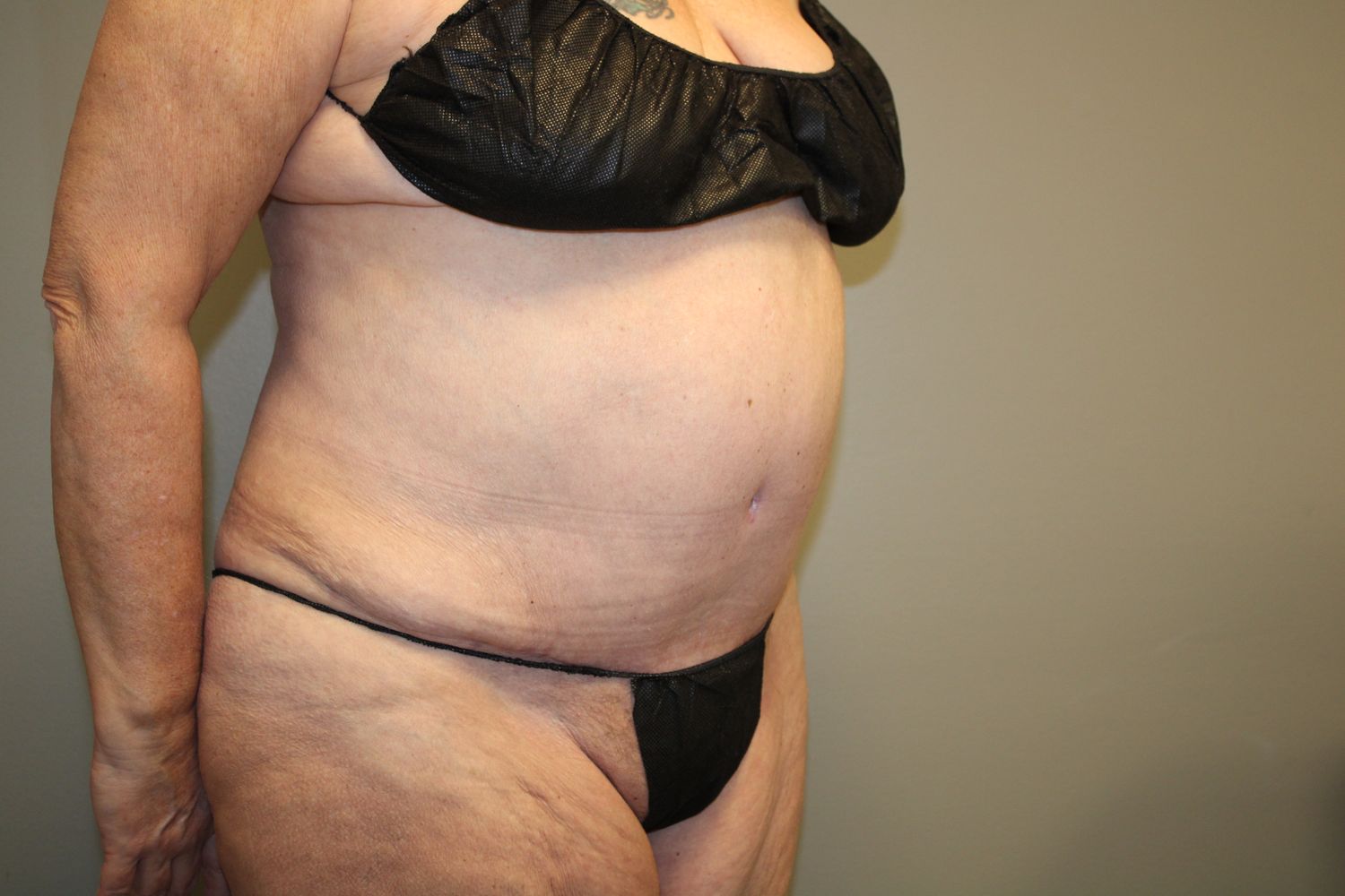 Tummy Tuck Before & After