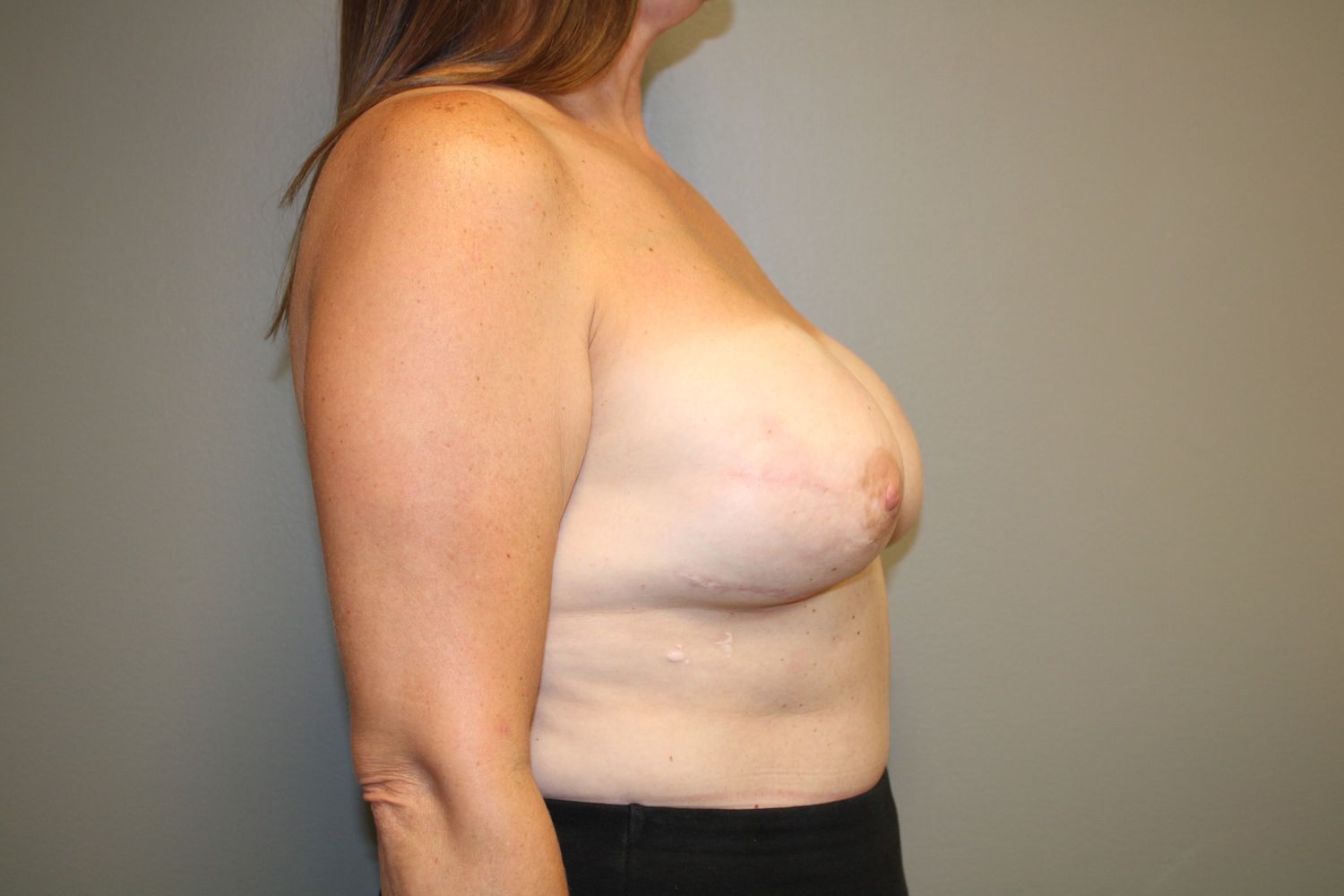 Breast Reconstruction Before & After