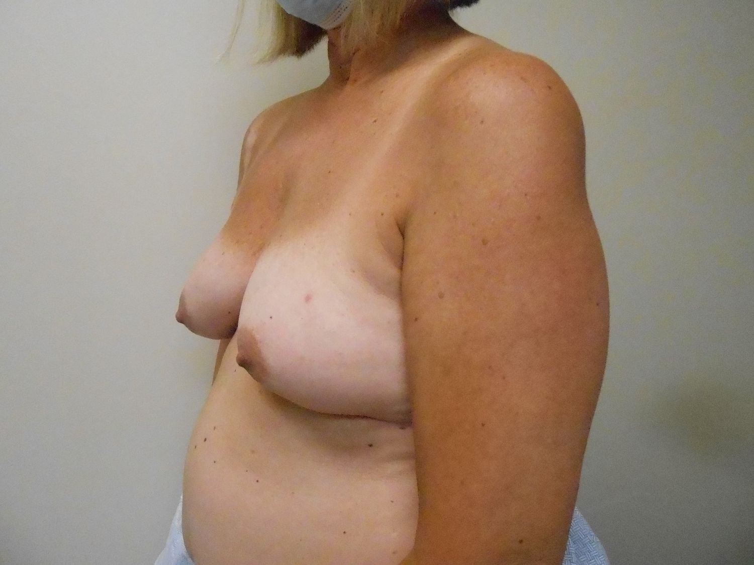 Breast Reconstruction Before & After