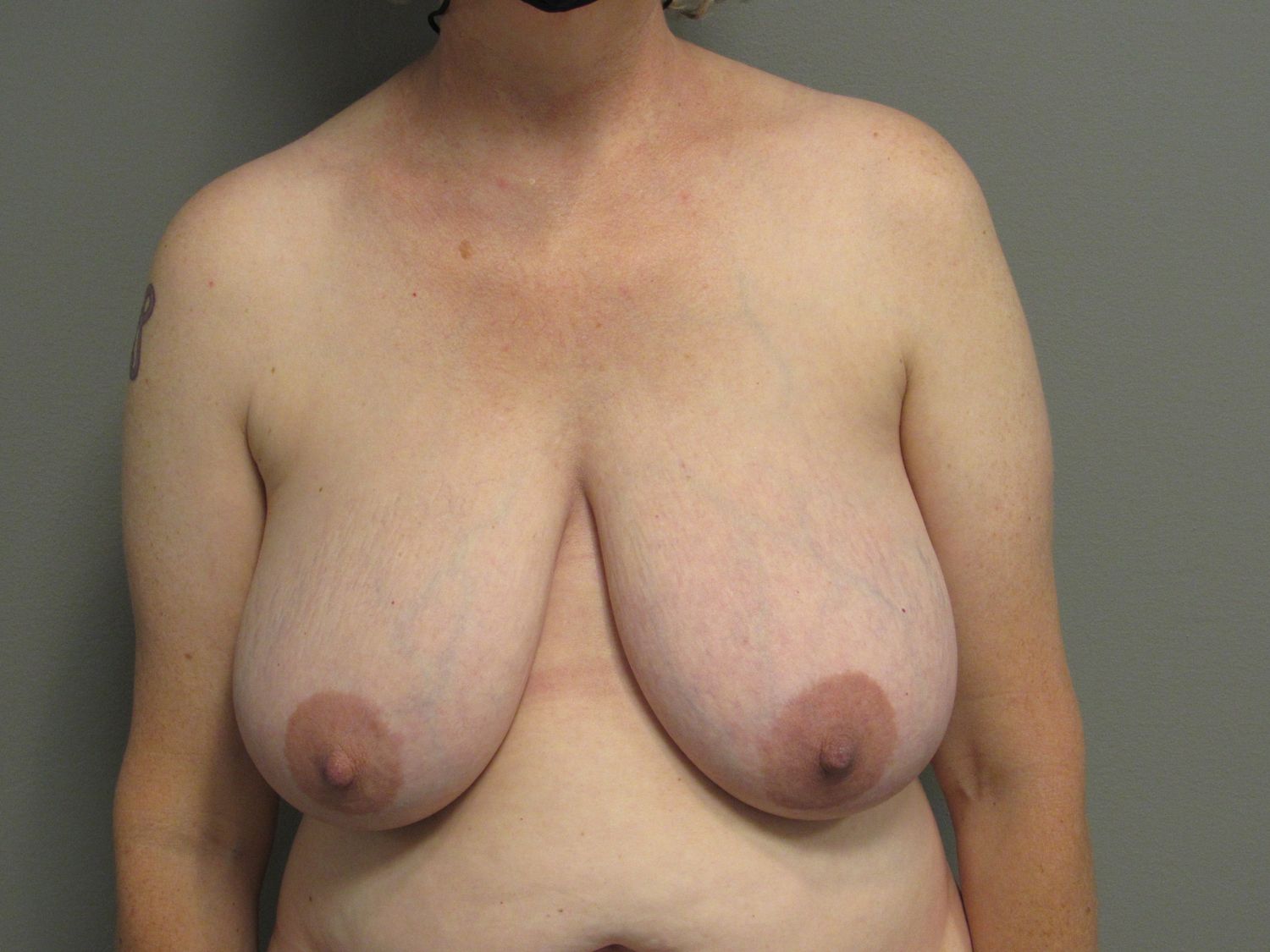 Breast Reduction Before & After