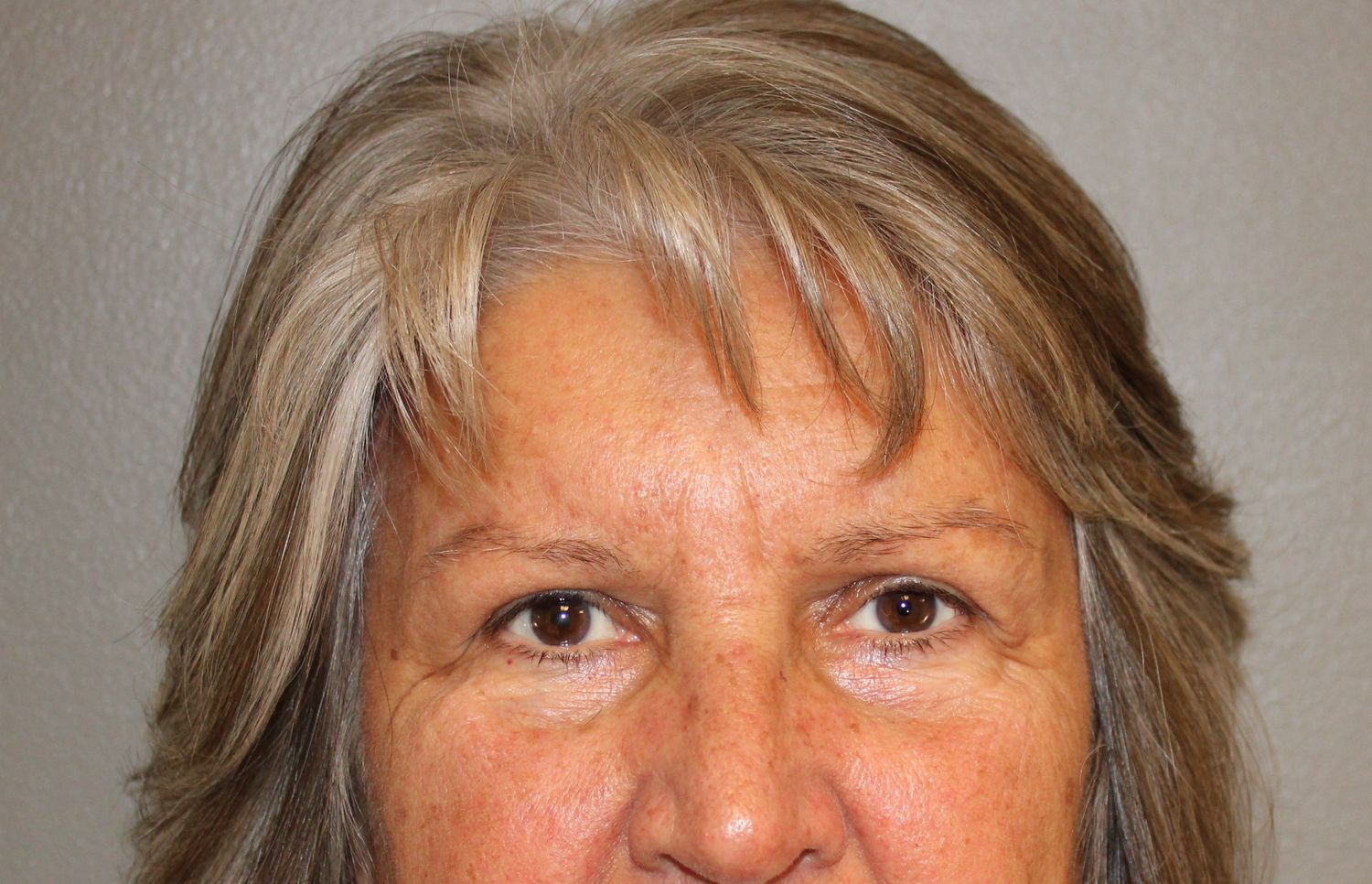 Blepharoplasty Before & After