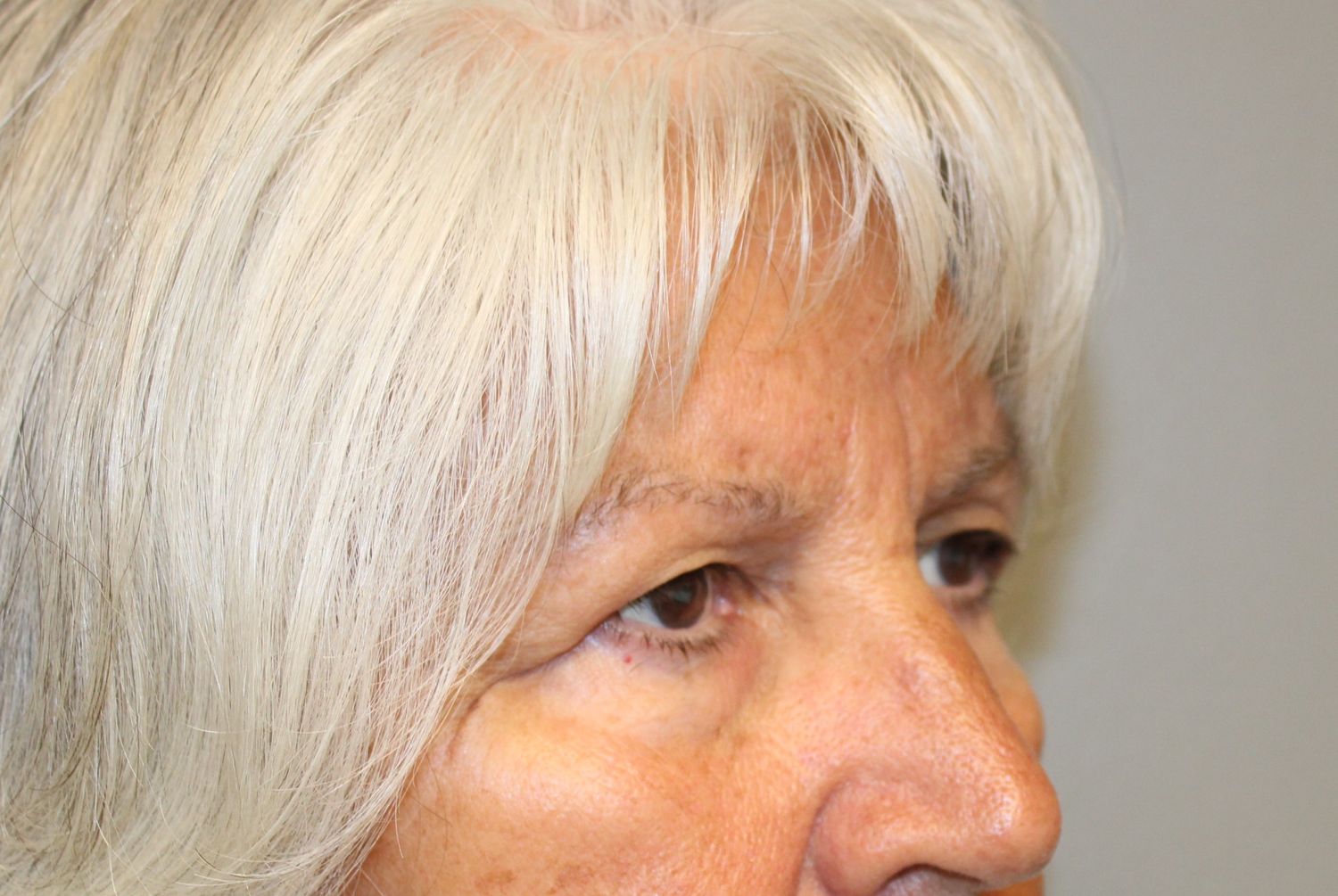 Blepharoplasty Before & After