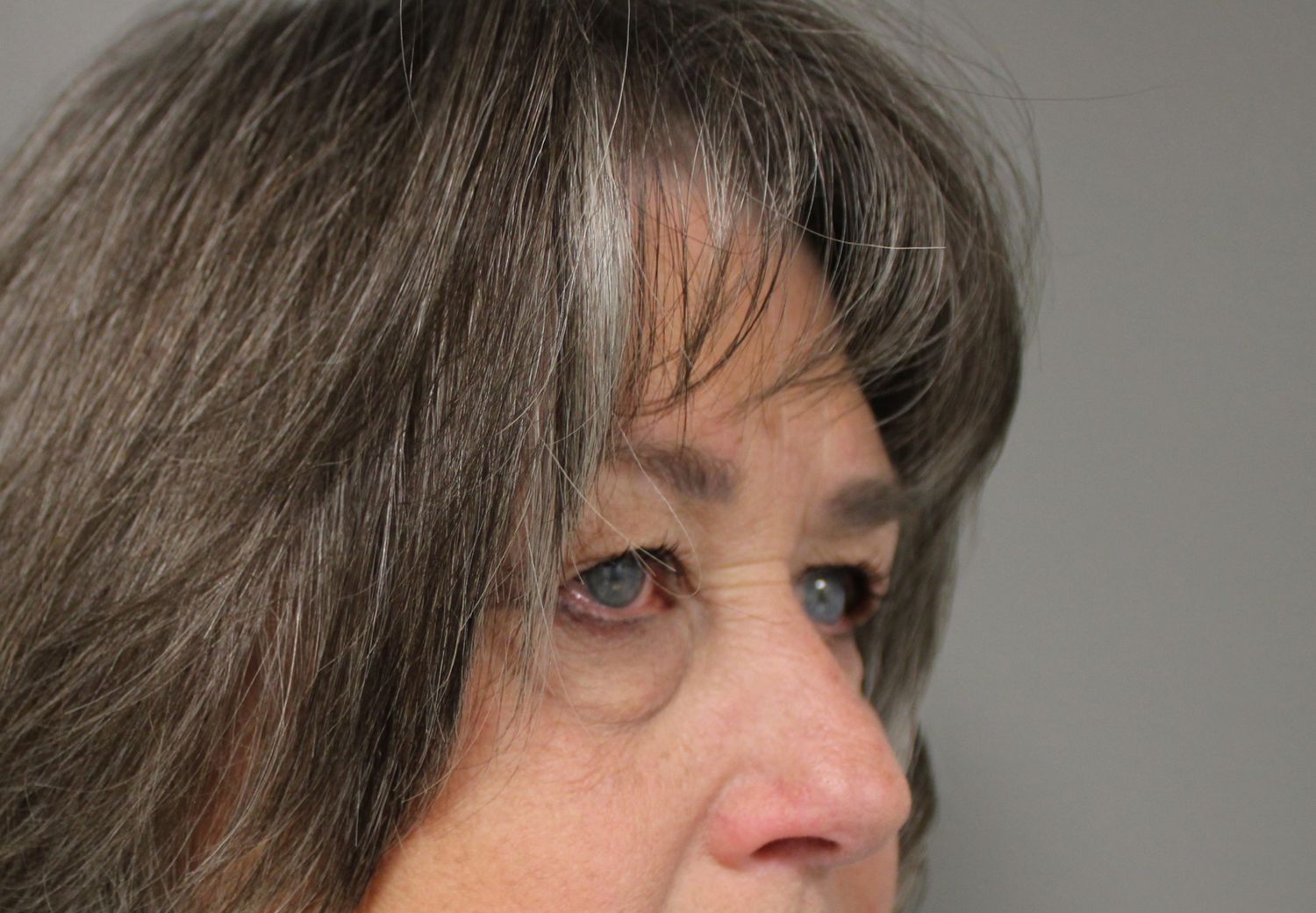 Blepharoplasty Before & After