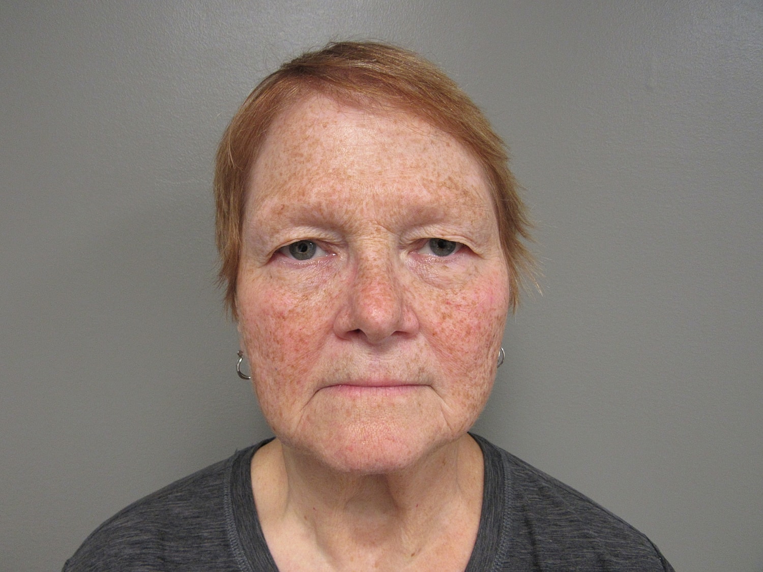 Blepharoplasty Before & After