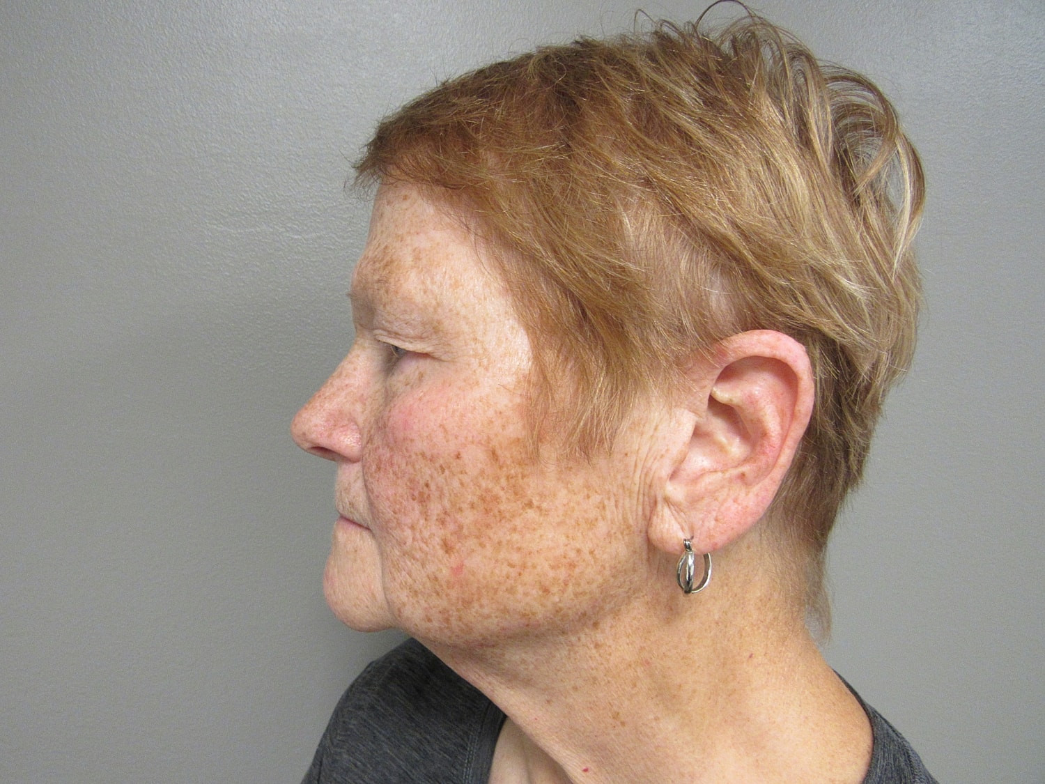 Blepharoplasty Before & After