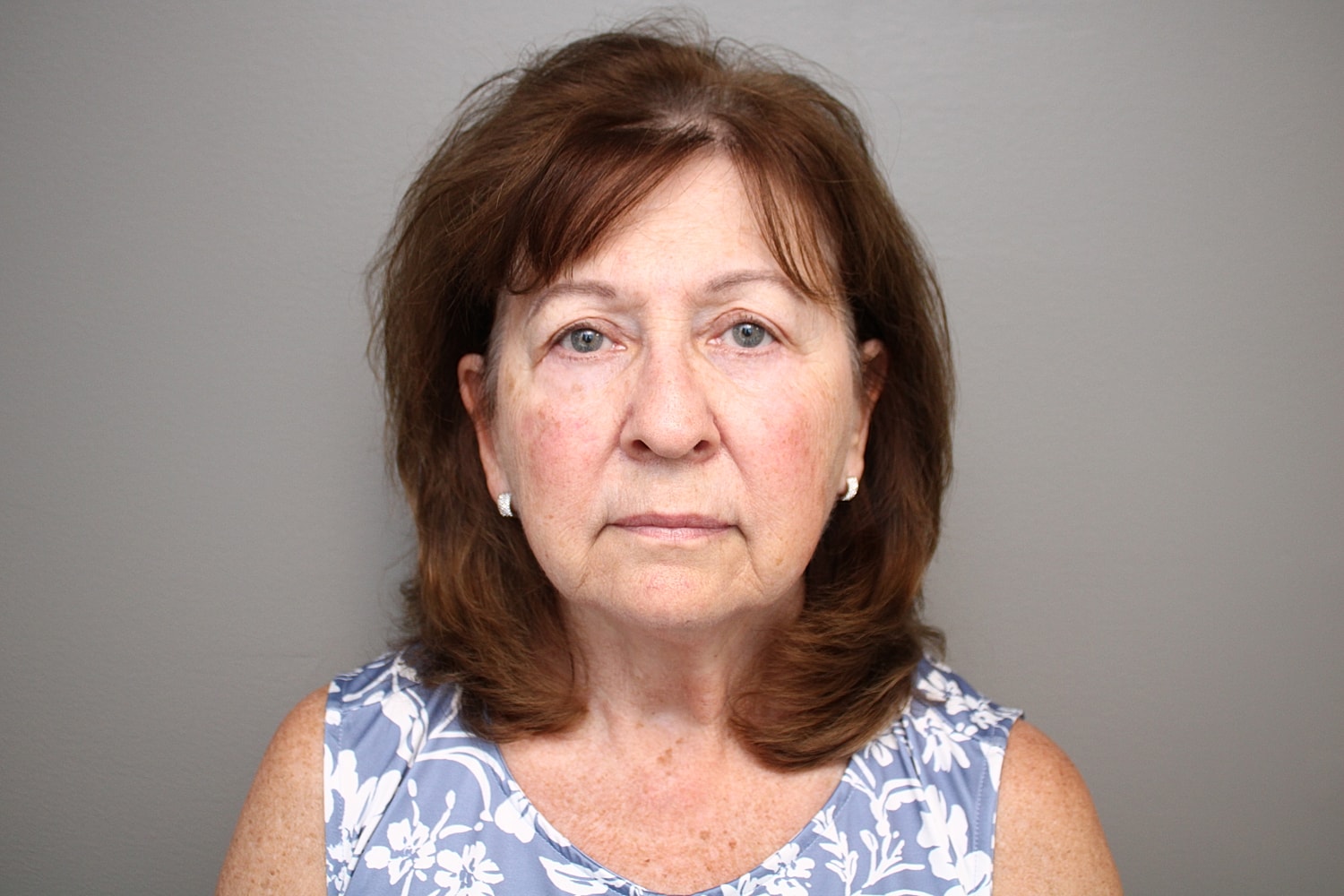 Blepharoplasty Before & After