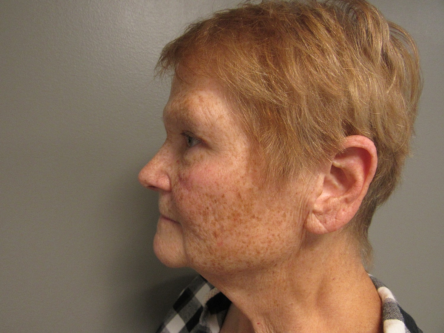 Blepharoplasty Before & After