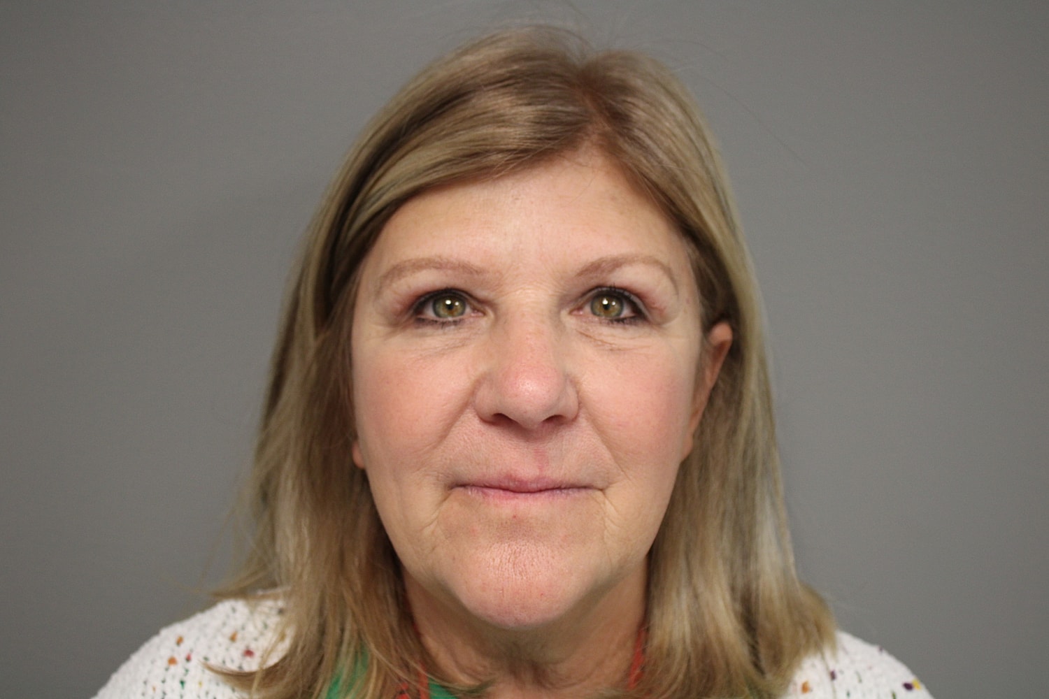 Blepharoplasty Before & After