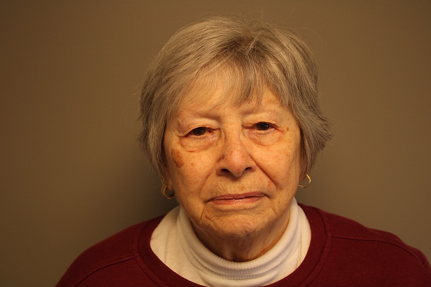 Blepharoplasty Before & After