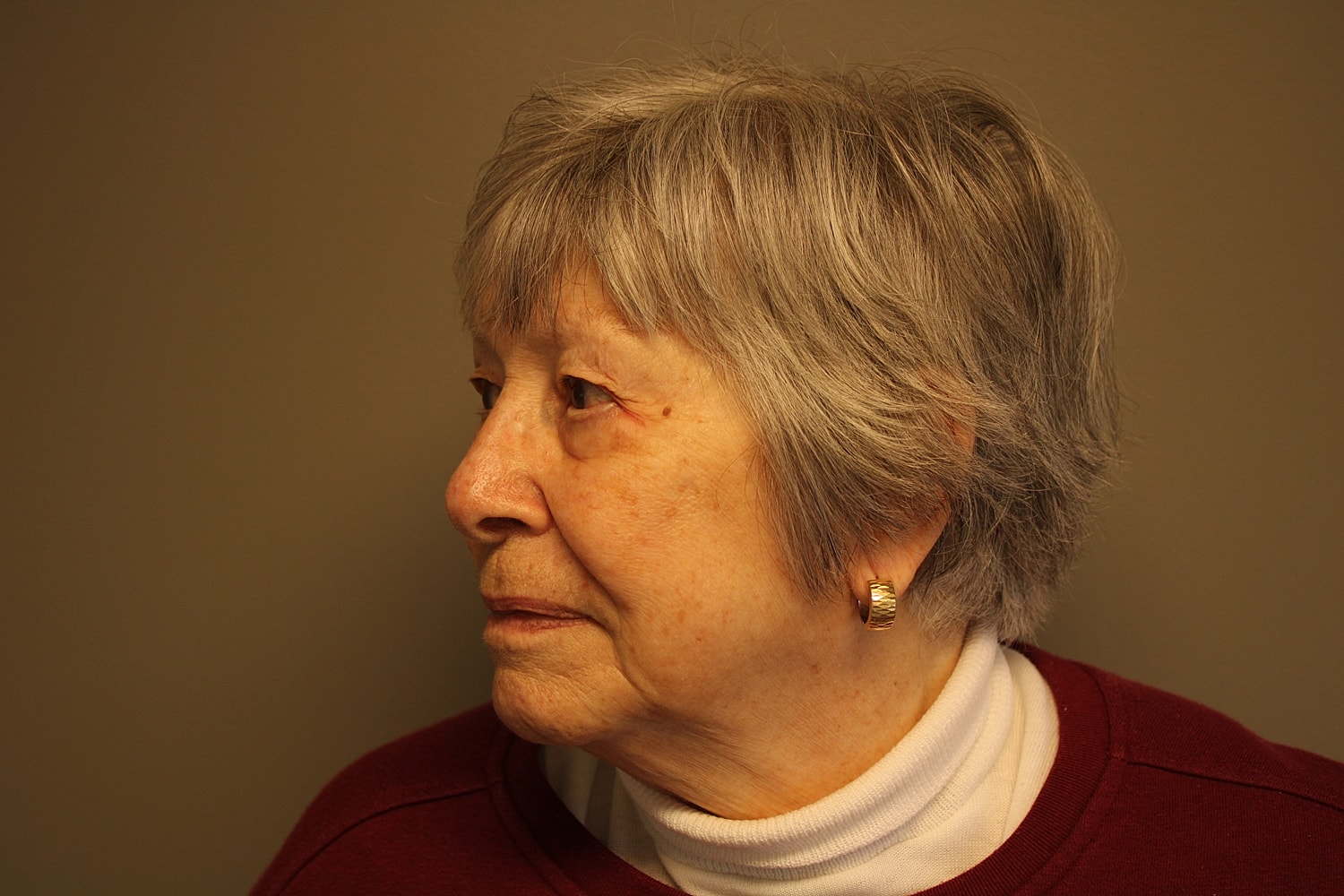 Blepharoplasty Before & After