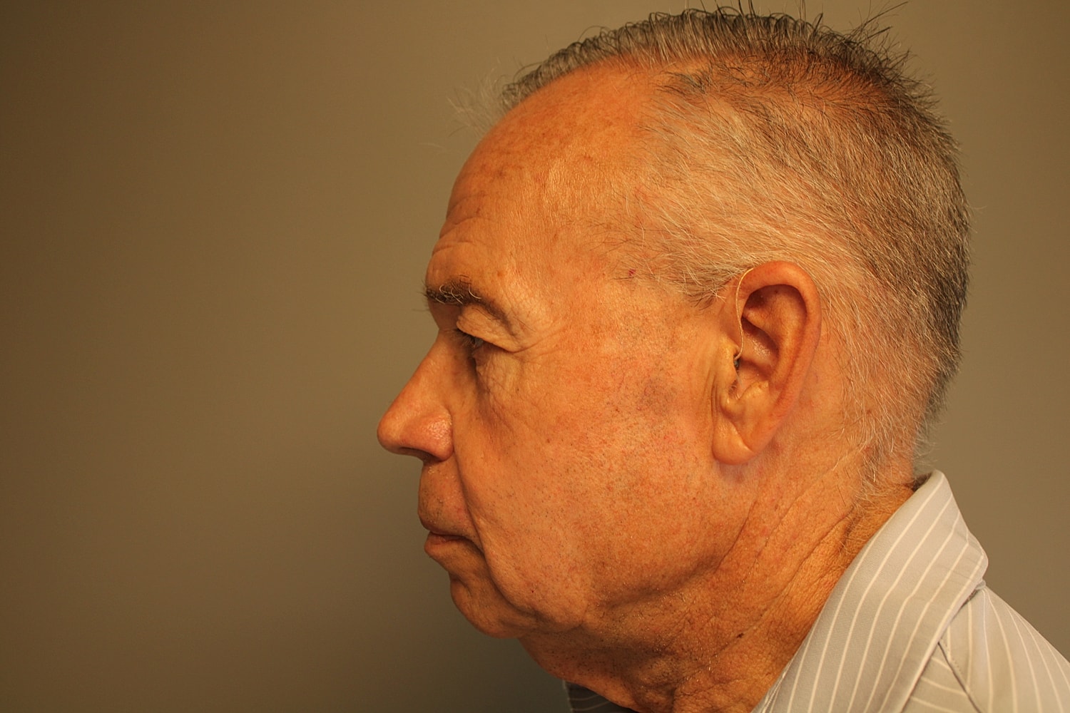 Blepharoplasty Before & After