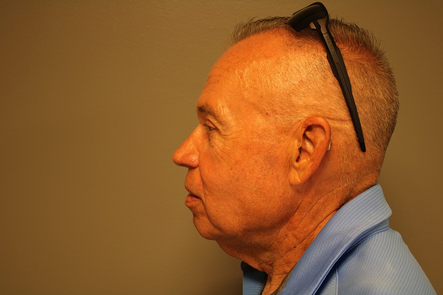 Blepharoplasty Before & After