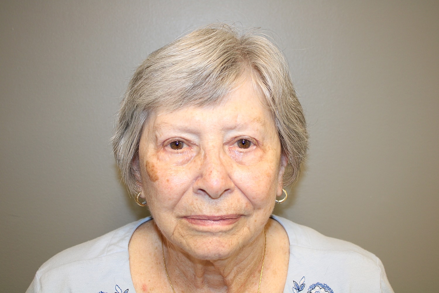 Blepharoplasty Before & After