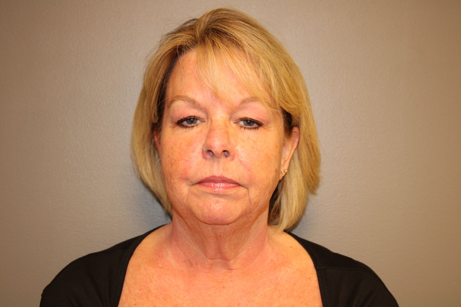 Facelift Before & After