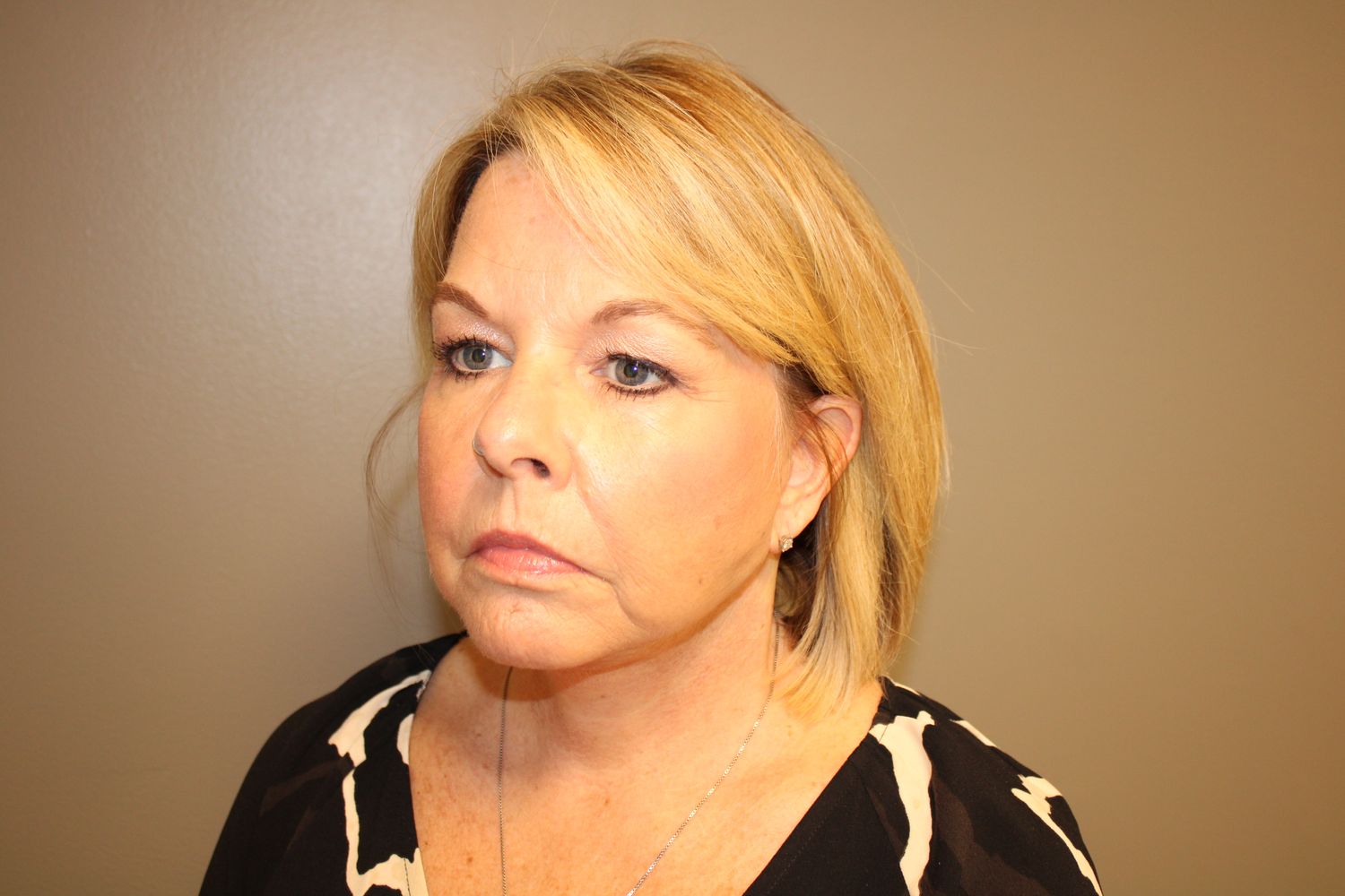 Facelift Before & After