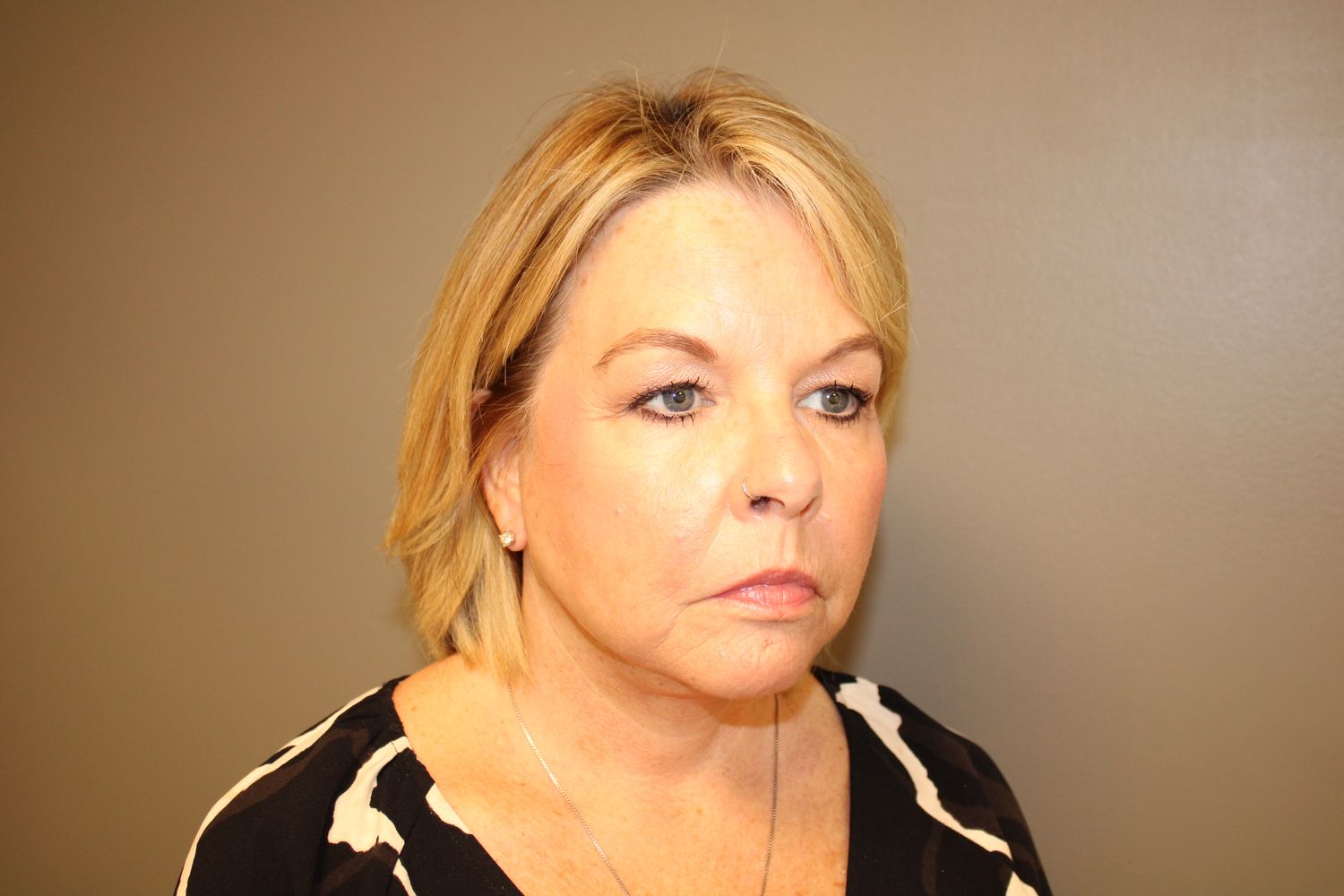 Facelift Before & After