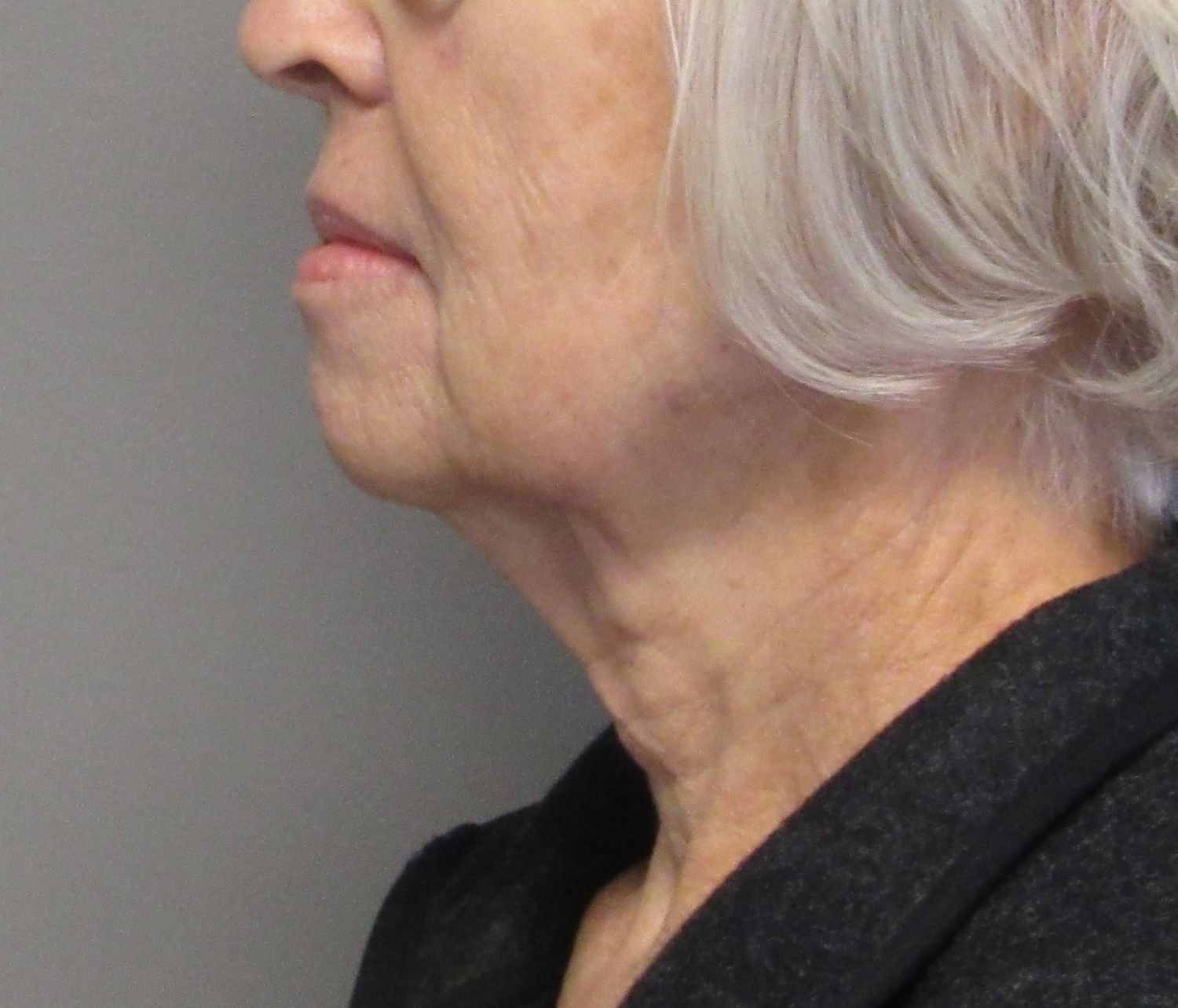 Facelift Before & After