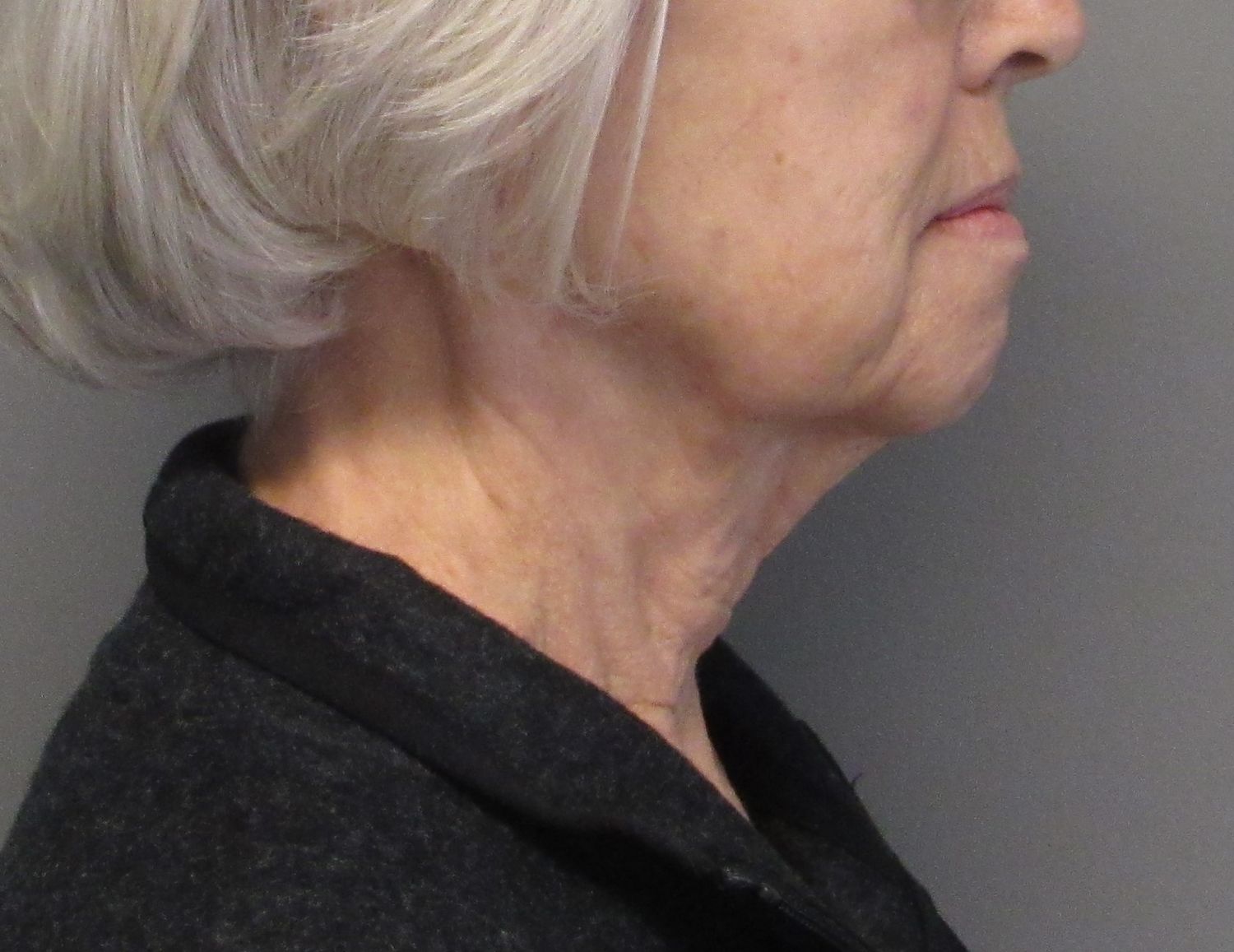 Facelift Before & After