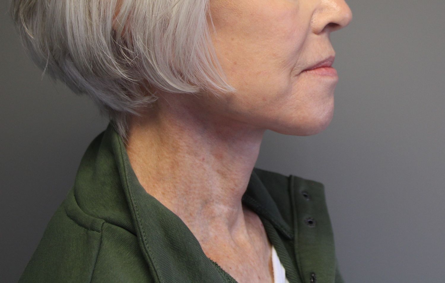 Facelift Before & After