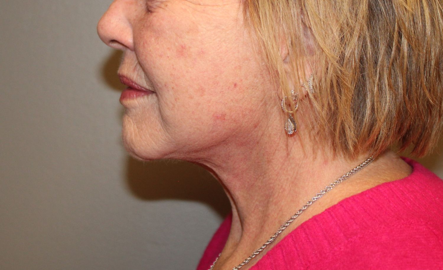 Facelift Before & After