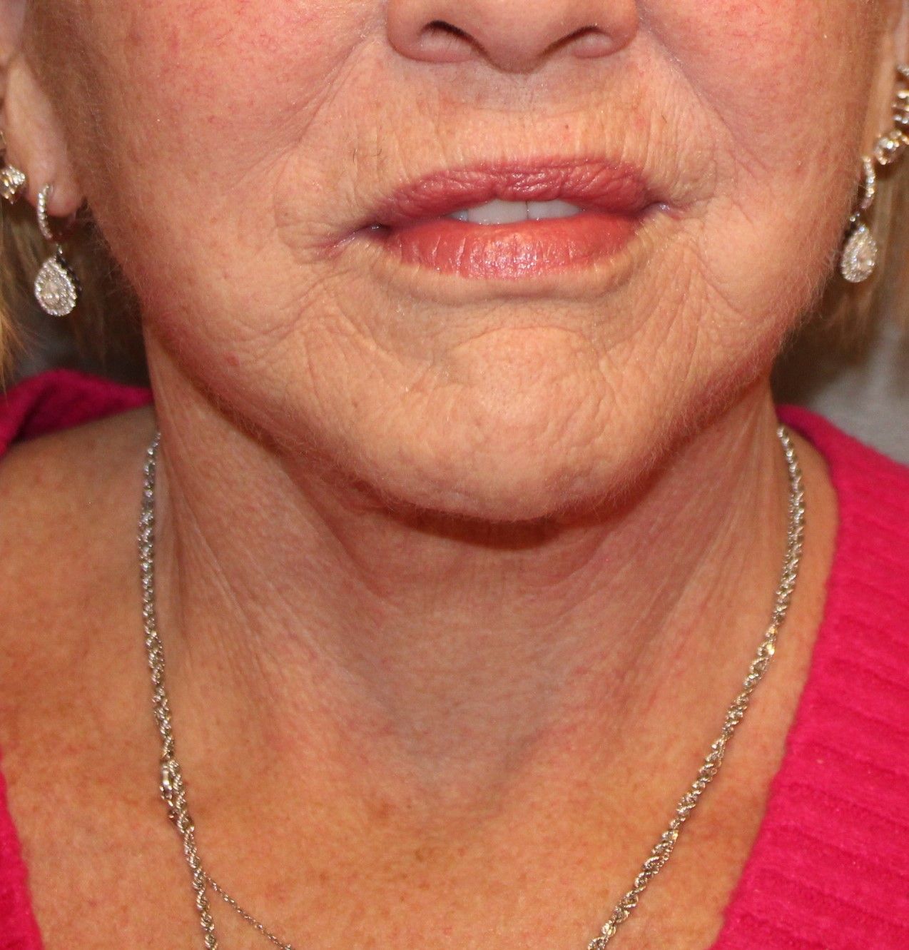 Facelift Before & After